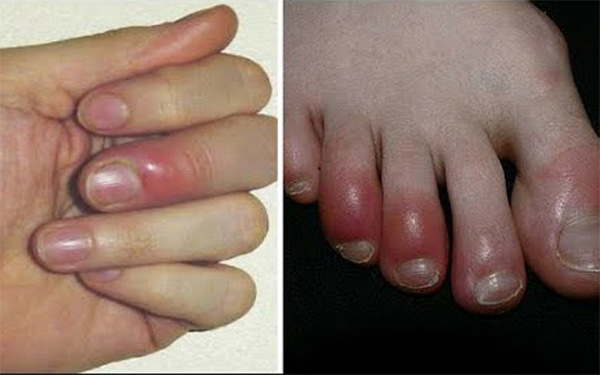 swelling of hands and feet