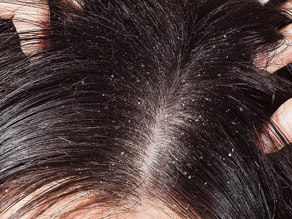 Dandruff