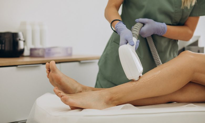 laser hair removal